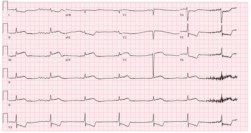 Electrocardiogram (ECG) utilizing time series data to assess heart health